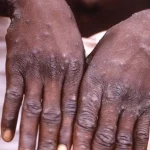 ugandada-m-cicegi-salgininda-can-kaybi-sayisi-37ye-yukseldi-Nb1MVVhV.jpg